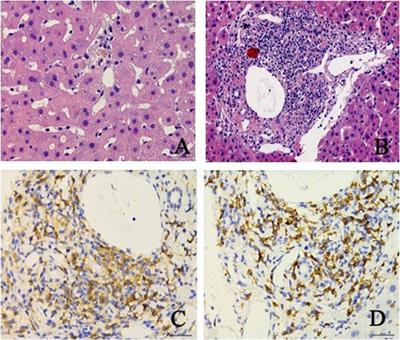 Difficulty in differentiating liver injury from an immune checkpoint inhibitor from chemotherapy